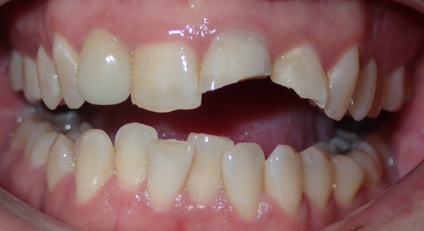 Before