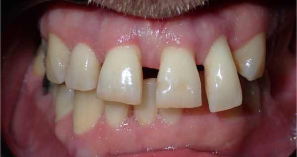 Before